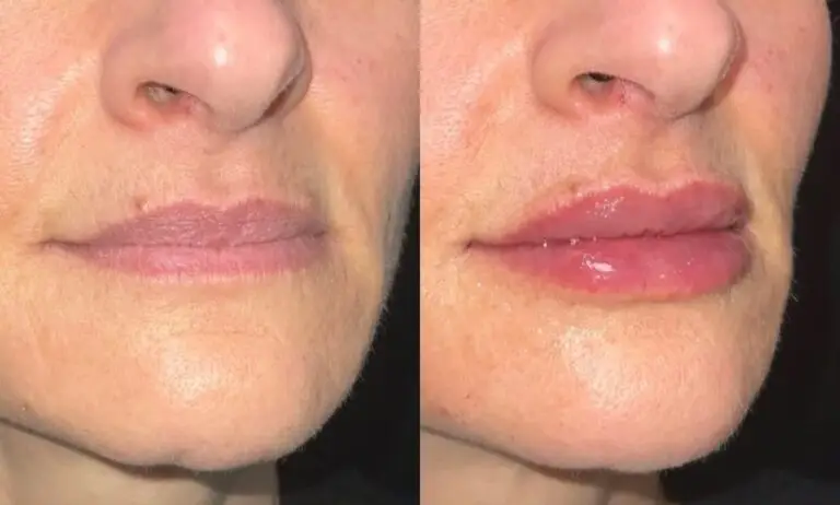 Lip-filler-before-after-10
