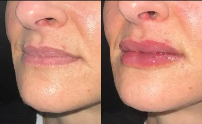Lip-filler-before-after-11