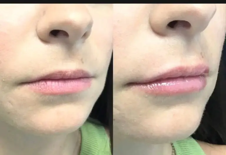 Lip-filler-before-after-5