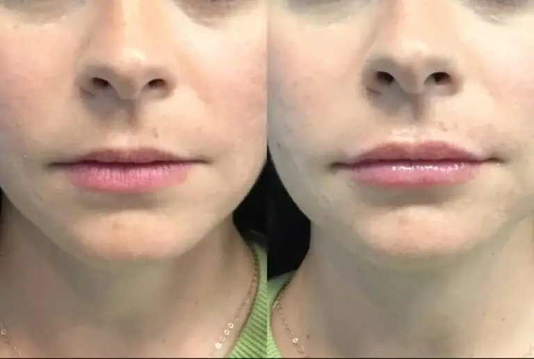 Lip-filler-before-after-6