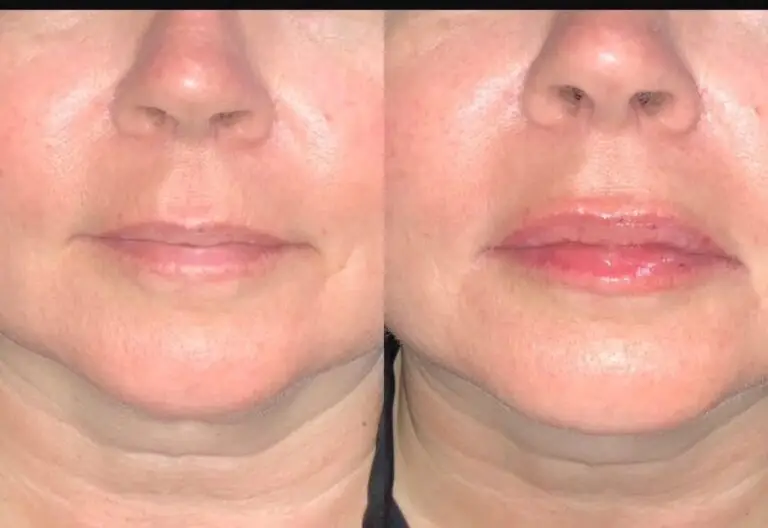 Lip-filler-before-after-7