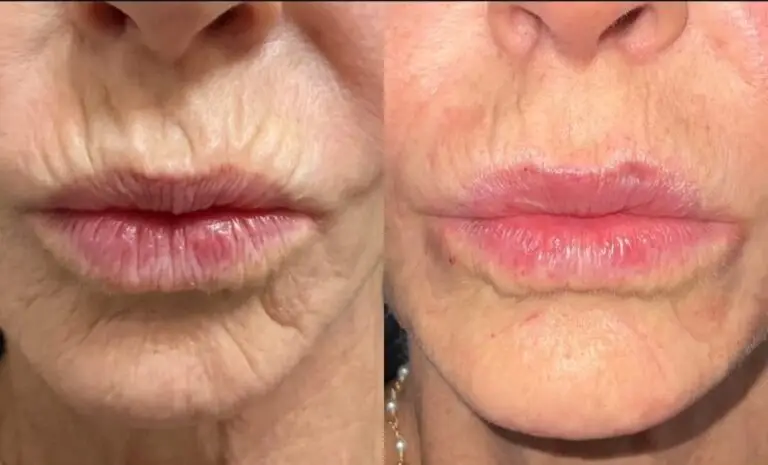 Lip-filler-before-after-8