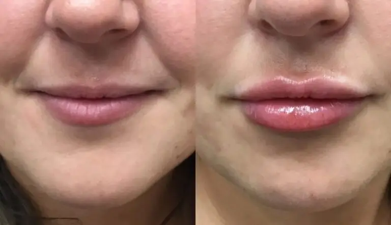 Lip-filler-before-after-Plaistow