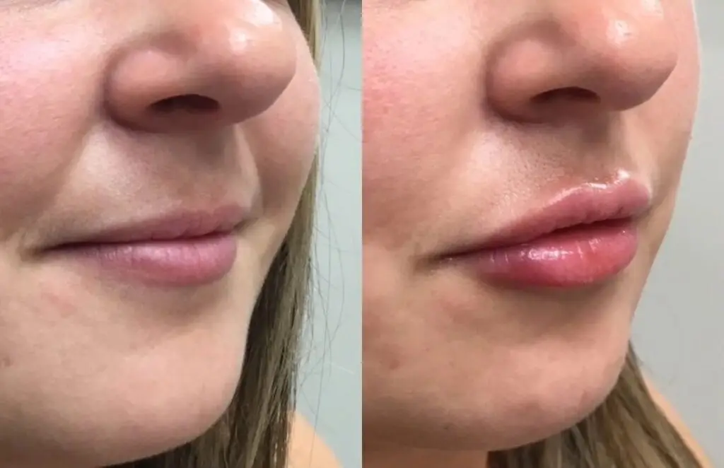 Lip Filler Plaistow NH