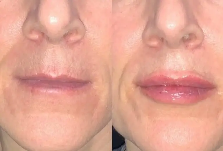 Lip-filler-before-after3