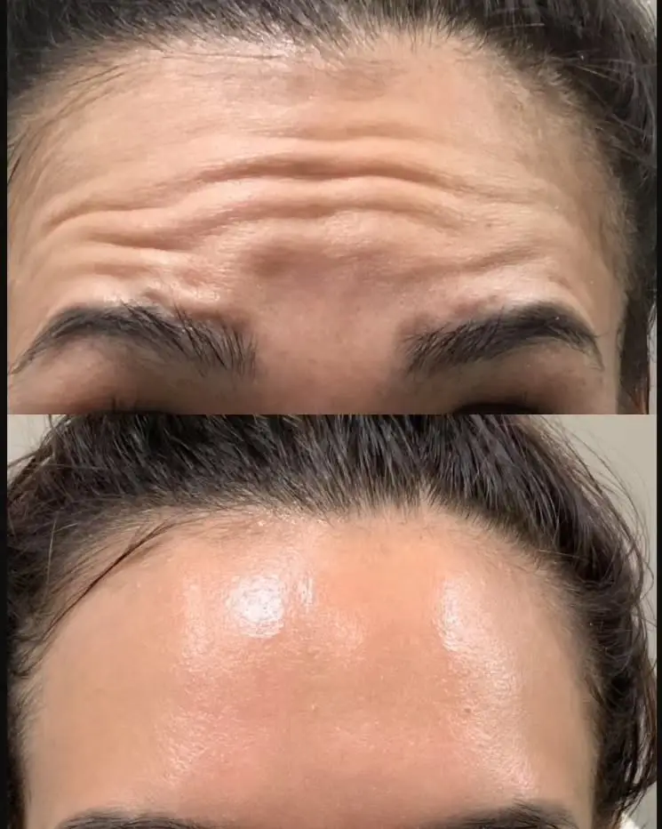 Botox Before and After Plaistow, NH