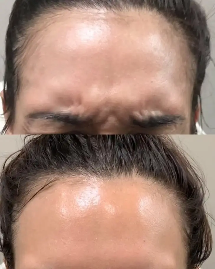 botox-before-after2