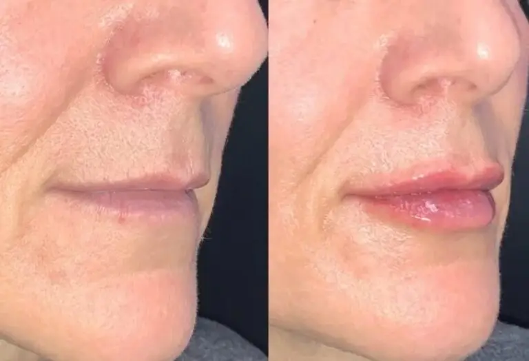 lip-filler-before-after-4