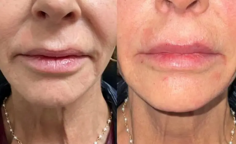 lip-filler-before-after-9