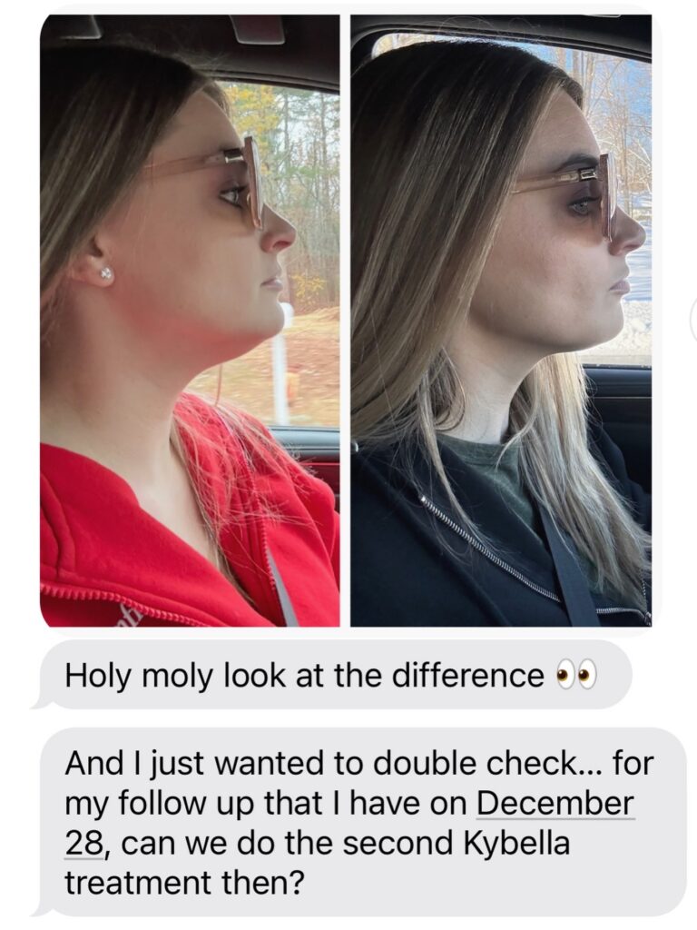 Kybella for neck plaistow nh