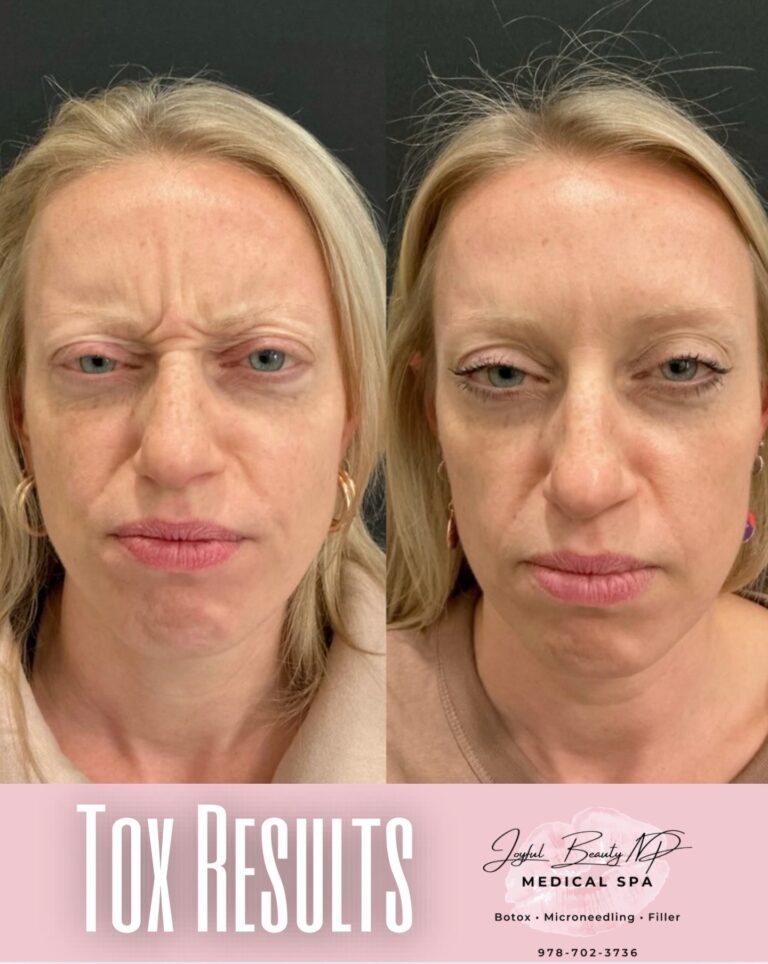 Botox, Dysport, or Letybo? How I Help Patients Choose