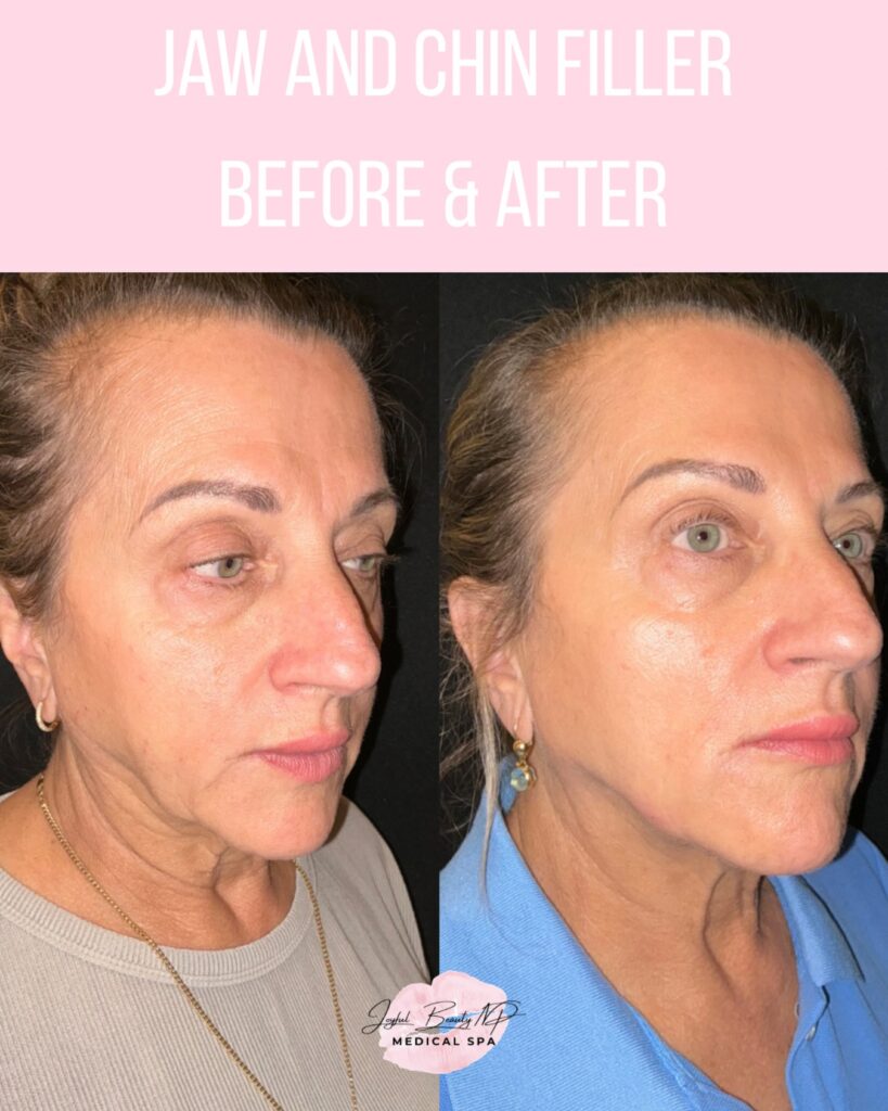 chin and jaw filler before and after plaistow nh